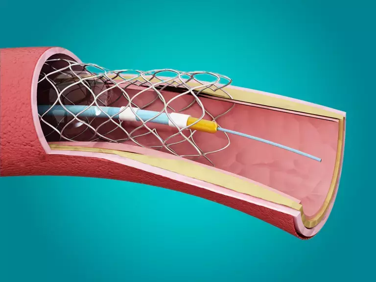Pressure Sensing for Angioplasty - Teaser Image